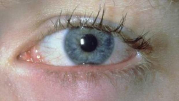 Ечемик на окото: причини и ефективни превантивни мерки